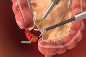 Appendix Surgery – M B Patel Hospital | Best Plastic Surgery Hospital